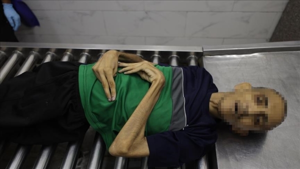 مسؤول صحي بغزة: إصابة ألف بالغ بسوء التغذية في 3 أسابيع